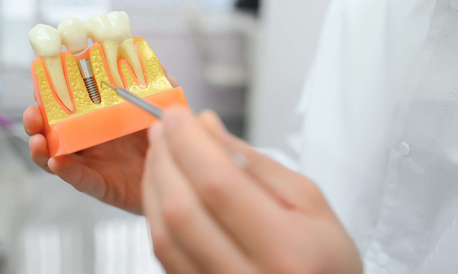 Impianti dentali e protesi: soluzioni avanzate per un sorriso completo Impianti dentali e protesi: soluzioni avanzate per un sorriso completo