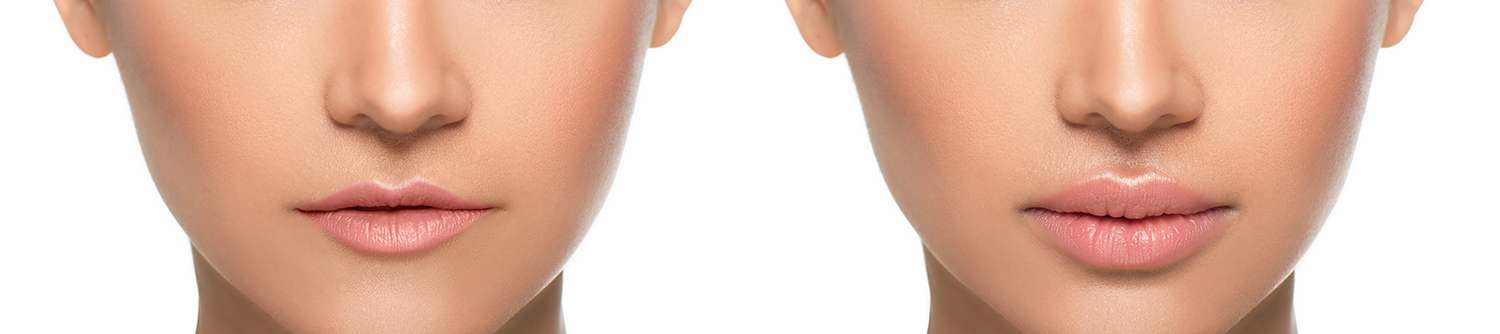 Filler labbra: valorizzare la naturale bellezza del sorriso