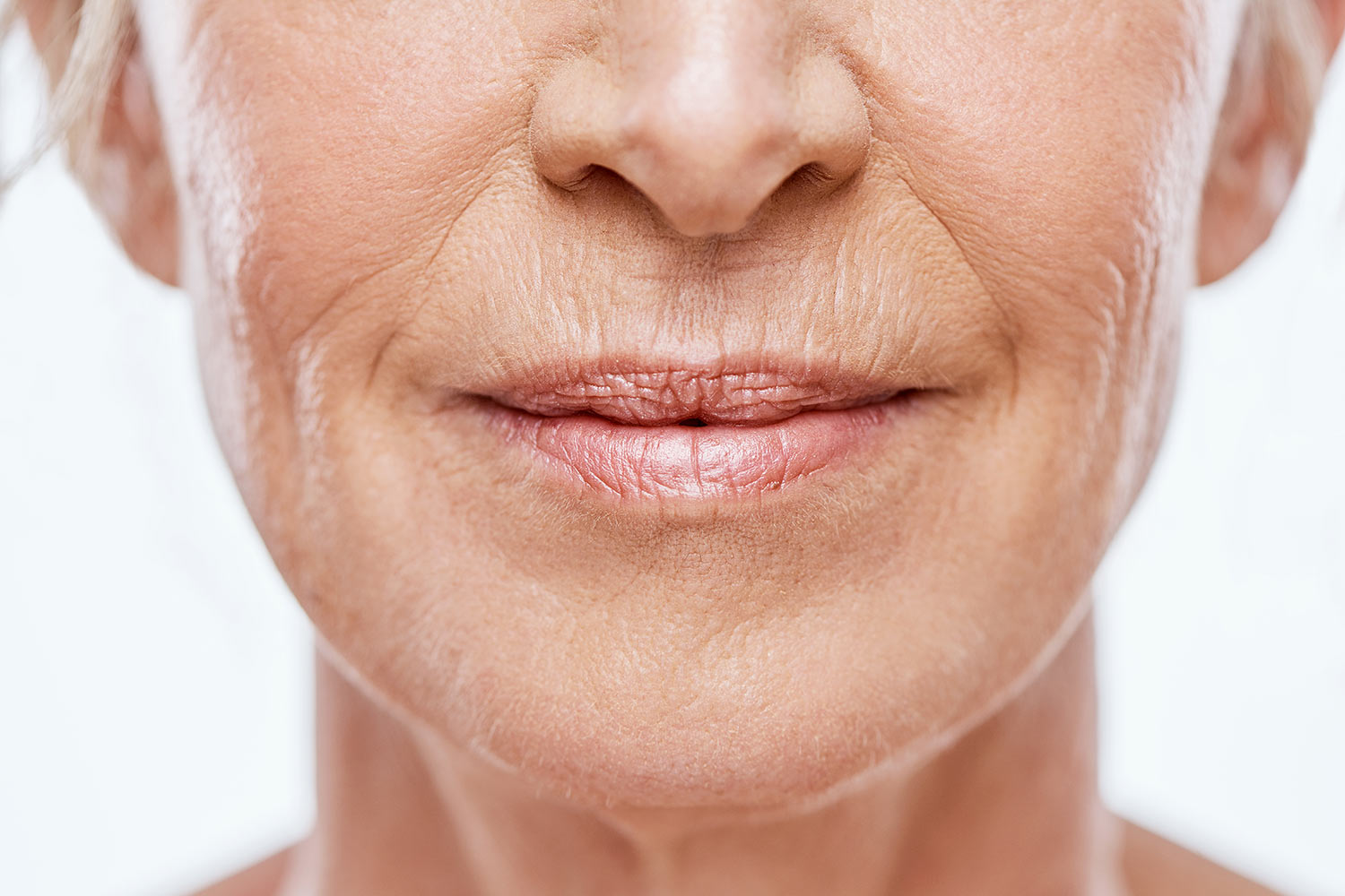 Filler rughe naso-labiali e della marionetta